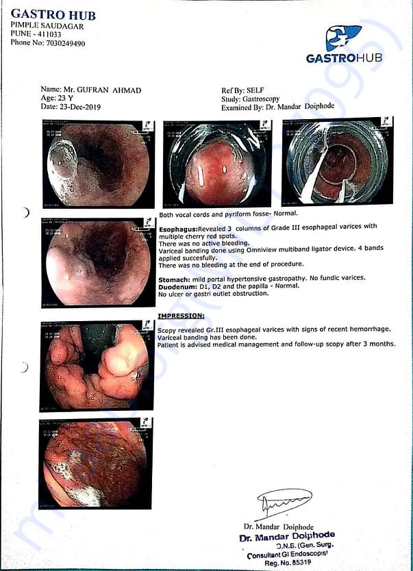 eosophageal varices with binding and continue per 3 month till death