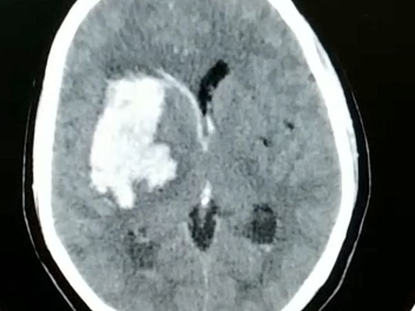 51 Years Old Sudha Jagadishan Needs Your Help Fight Brain Haemorrhage