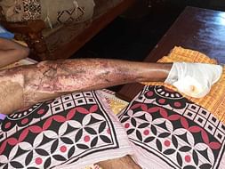 Support Sagar Recover From Accident (Leg Injury)