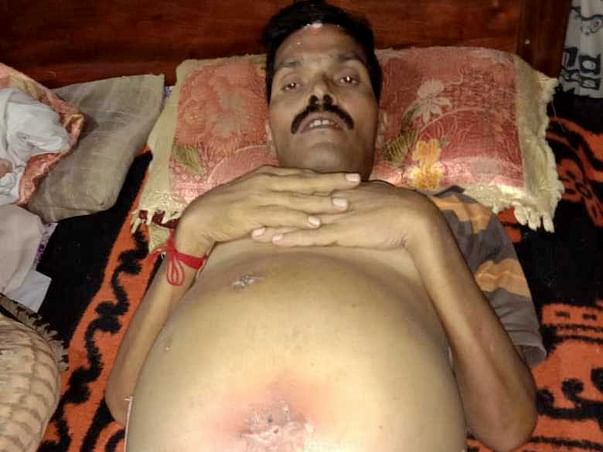 Support Bimalendu Dash Recover From Chronic Liver Disease