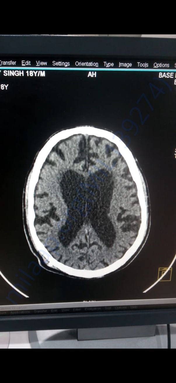 MRI Scan