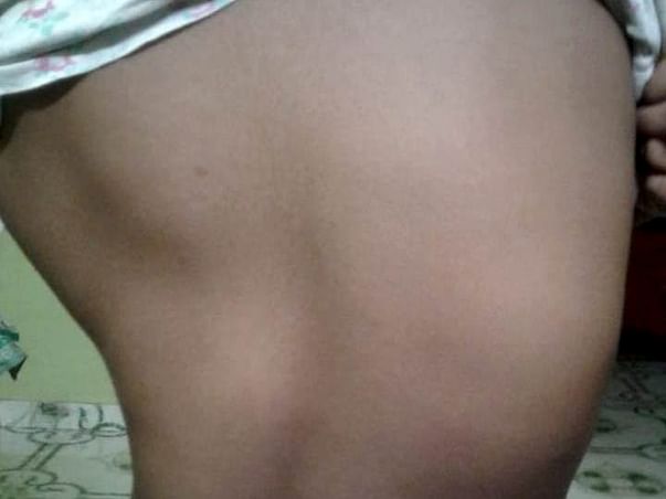 Help me fight BACK BONE BEND PROBLEM