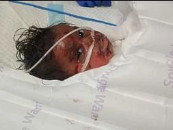 Support Rakshan Recover From Severe Burns