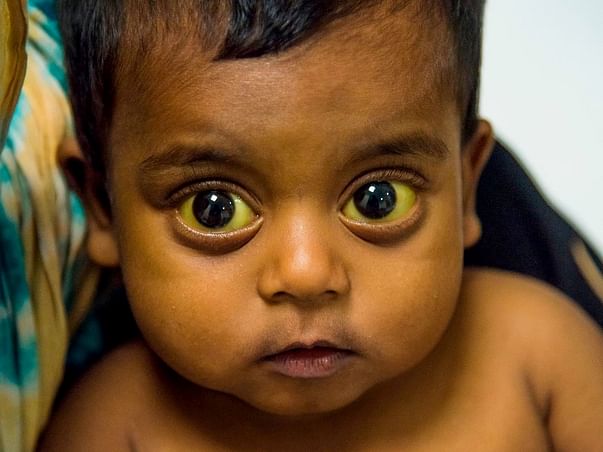 Adeen needs an urgent Liver Transplant and needs your help