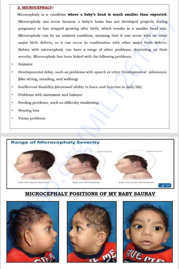 2) MY BABY WITH MICROCEPHALY