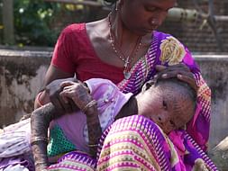 Help 7-year old Babita recover from a rare skin disorder