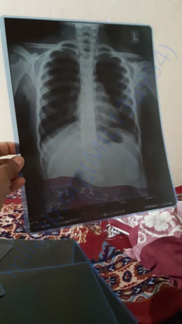 X-RAY