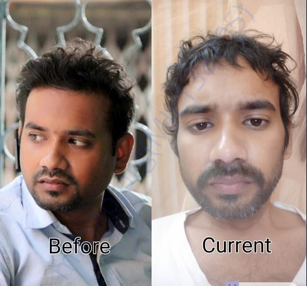Update. Picture before CANCER and after first CHEMO. GAP OF 5 MONTH