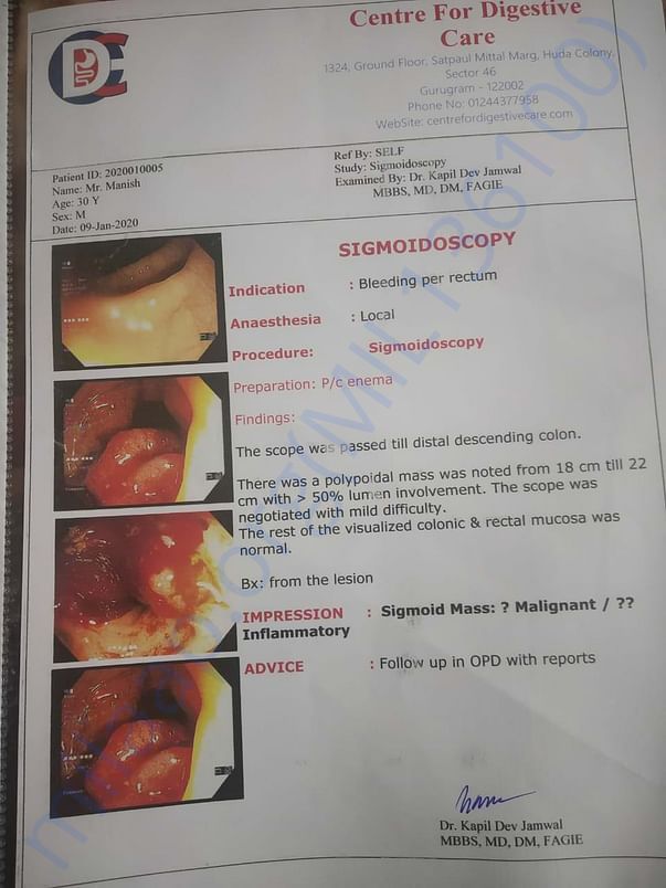 Sigmoidoscopy