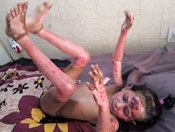 7 Years Old Subhasmita Sahoo Needs Your Help Fight Body Burn