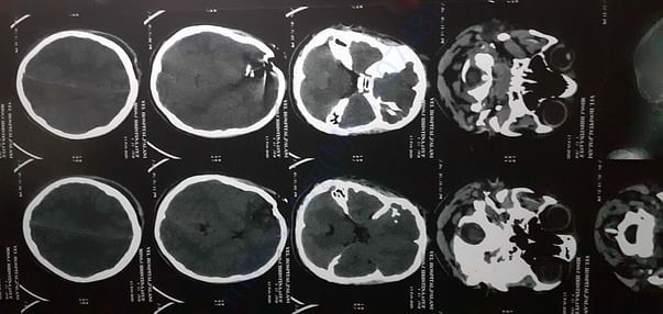 XRAY