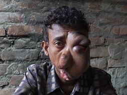 28-YO Man Has A Painful Tumour On His Face