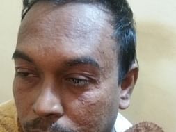 Support Paul Recover From Extreme Psoriasis