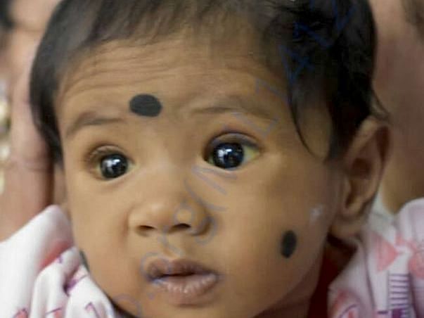 6 Months Old Baby Need Your Support Fighting From Liver Cirrhosis