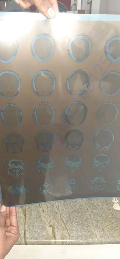 MRI Scan