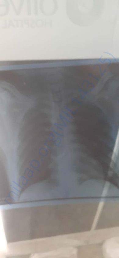 Chest X-Ray