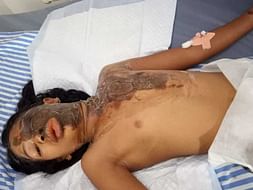 9 Years Old Bhabya Needs Your Help Fight Body Burn