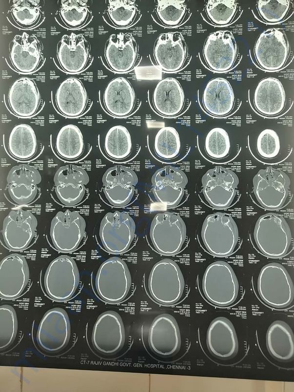 CT scan