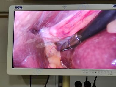 biopsy