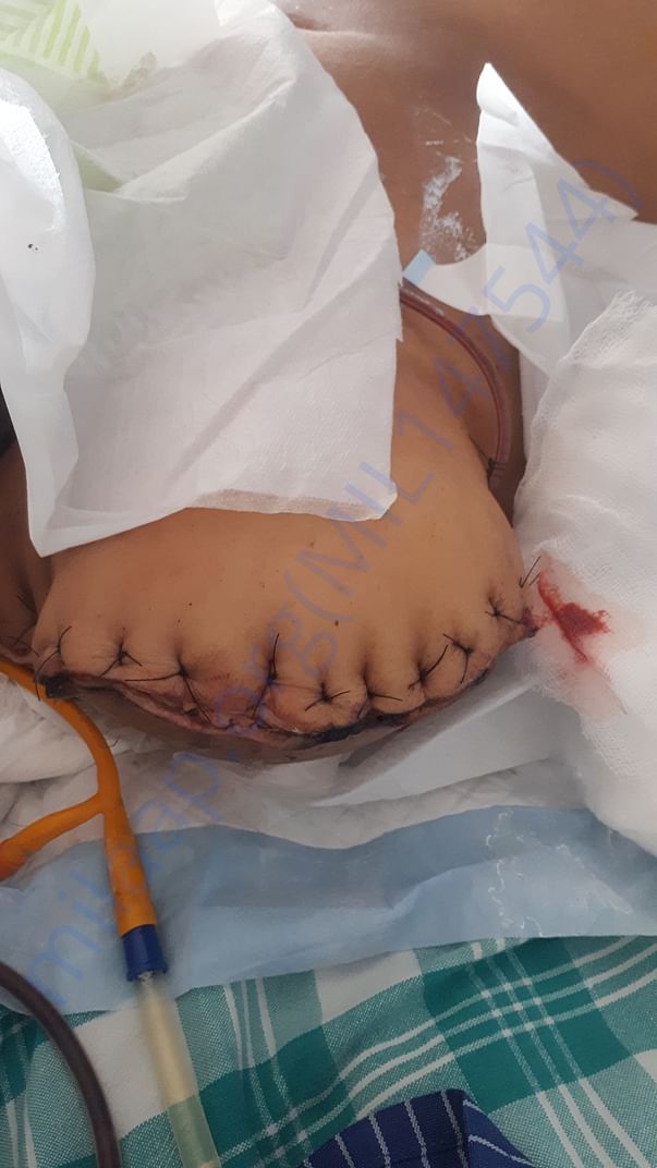 After operation