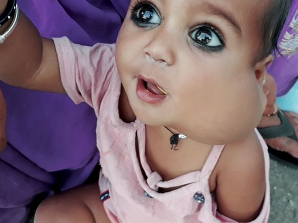 1 Year Old Ananya Needs Your Help Fight Her Swelled Cheek