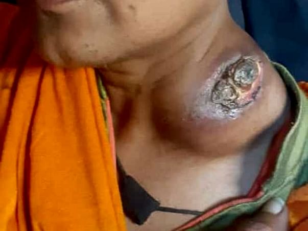 38 Years Old Muriel Needs Your Help Recover Throat Cancer