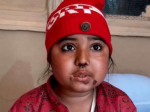 Rare Disease Leaves 13yr-Old Girl's Face Covered In Painful Blisters