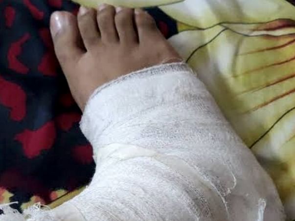 Support Sreeja Recover From Leg Injury