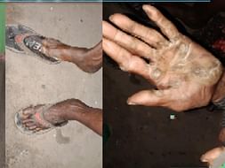 Support Sanchar Bhuyai Recover From Leg Infection