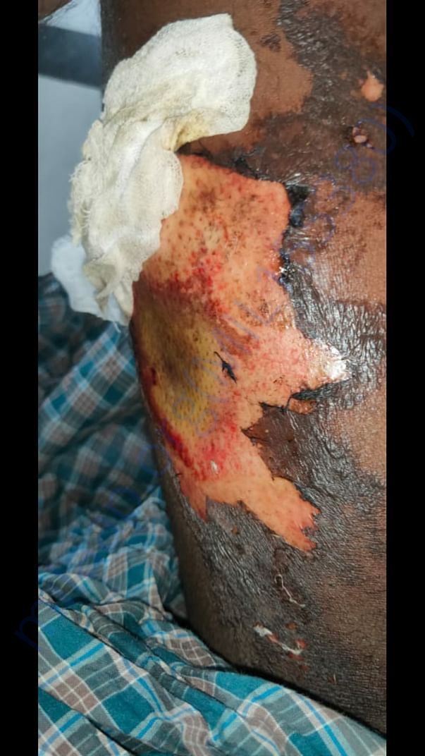 Severe burns