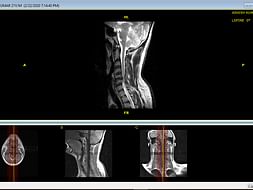 I’m Struggling With Spinal stenosis,Help Me