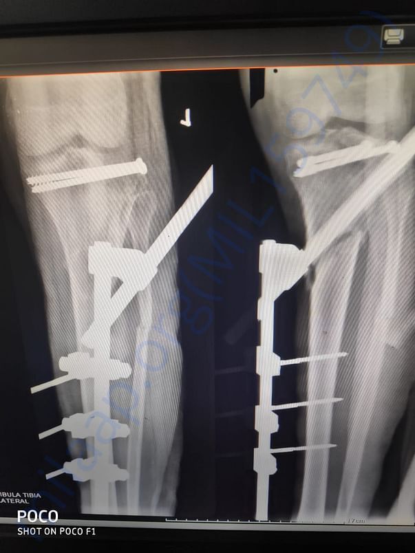 two legs fractur x-ray.