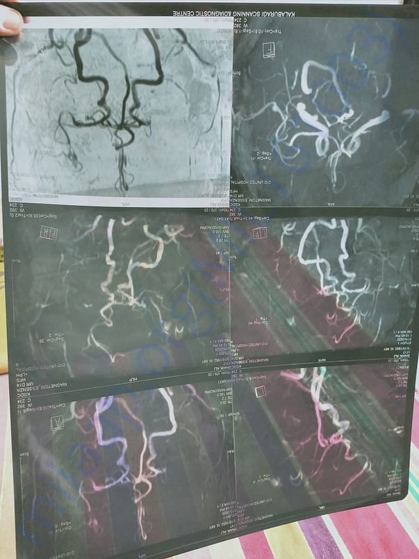 CT scan