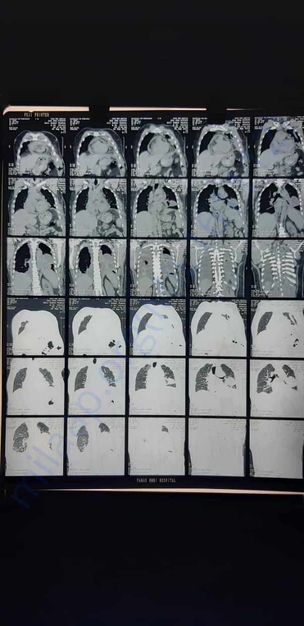 Ctscan
