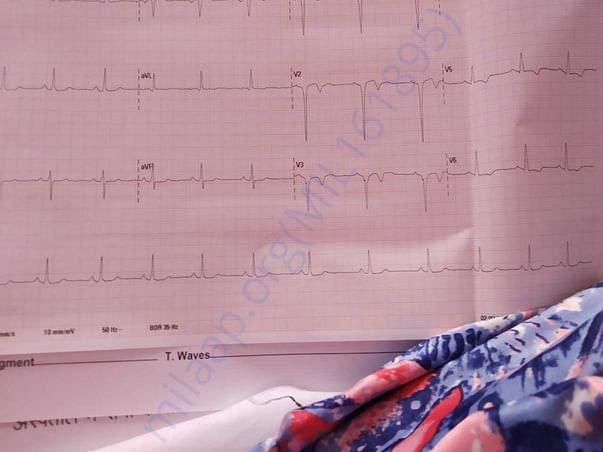 ECG