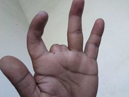 Help me fight accident injuries(left-hand finger amputated)