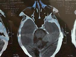 My Father Is Struggling With Brain Stroke And Paralysis: Help Him