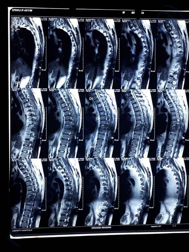 Spinal
