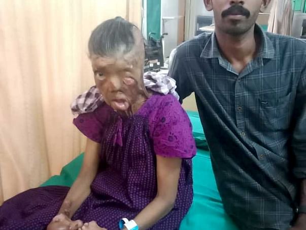 53 Years Old Ushakumari R Needs Your Help Recover Body Burn