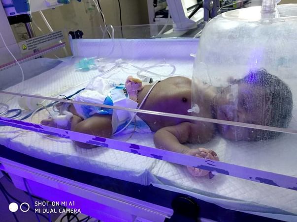 Help This 7 Days Old Fight Meconium Aspiration Syndrome
