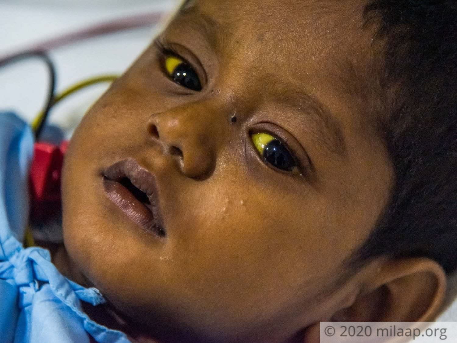 This 1YearOld Is Vomiting Blood Due To A Dangerous Disease, Needs An
