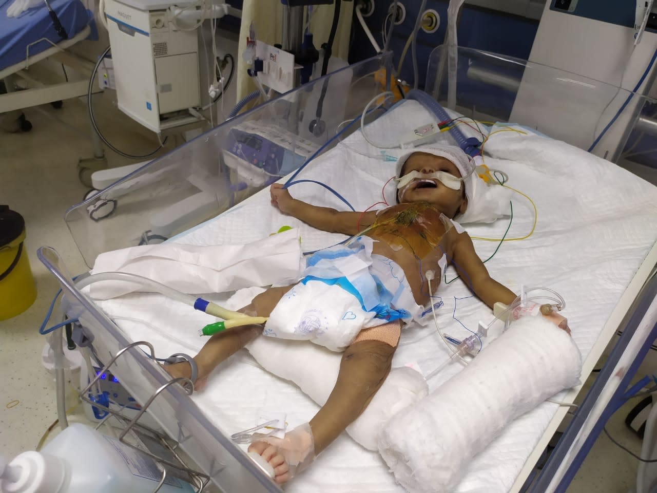 After A Major Heart Surgery This Baby Is Now Struggling To