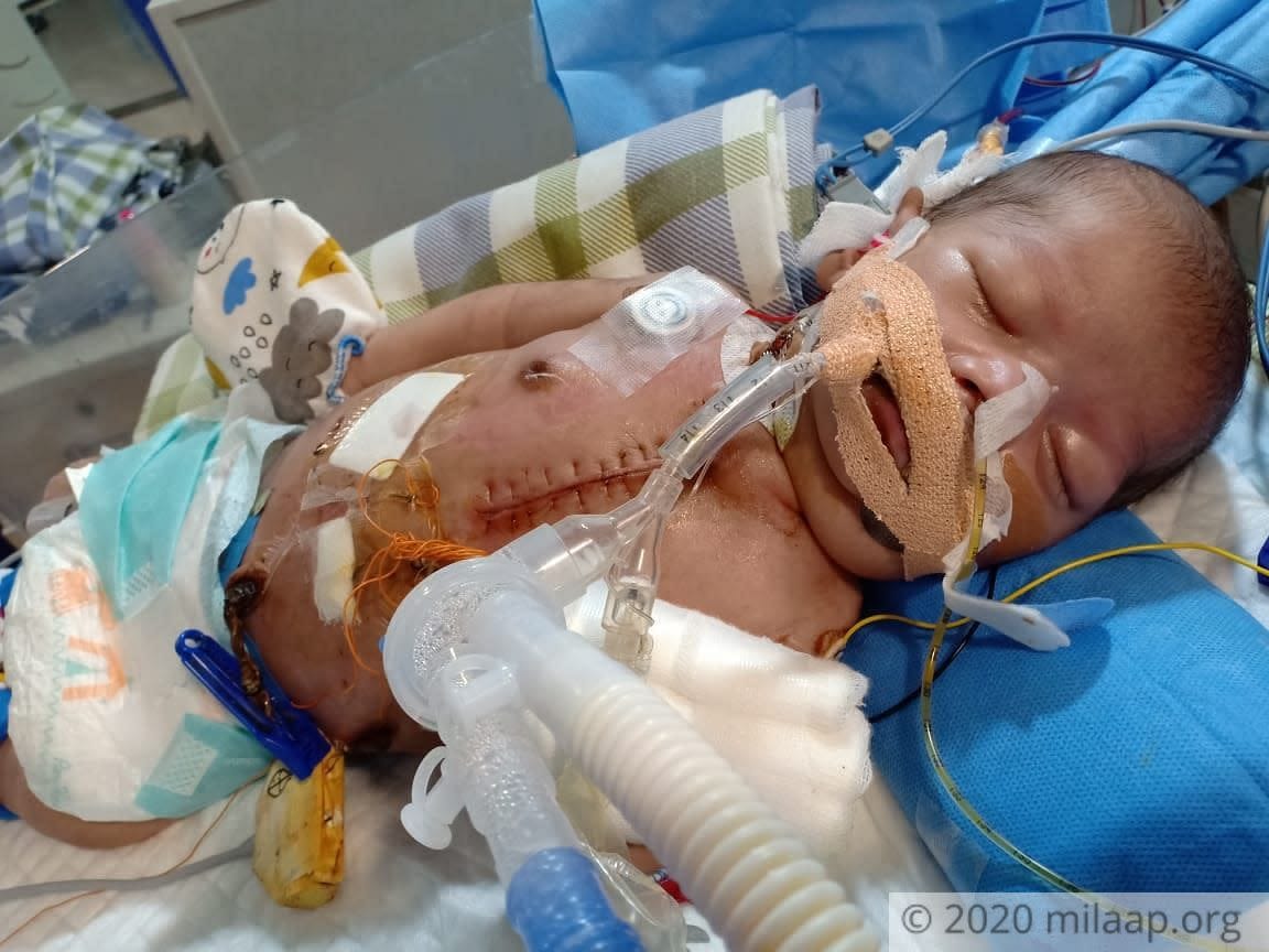 The Large Scar On This Newborn’s Chest Tells The Painful Story Of His