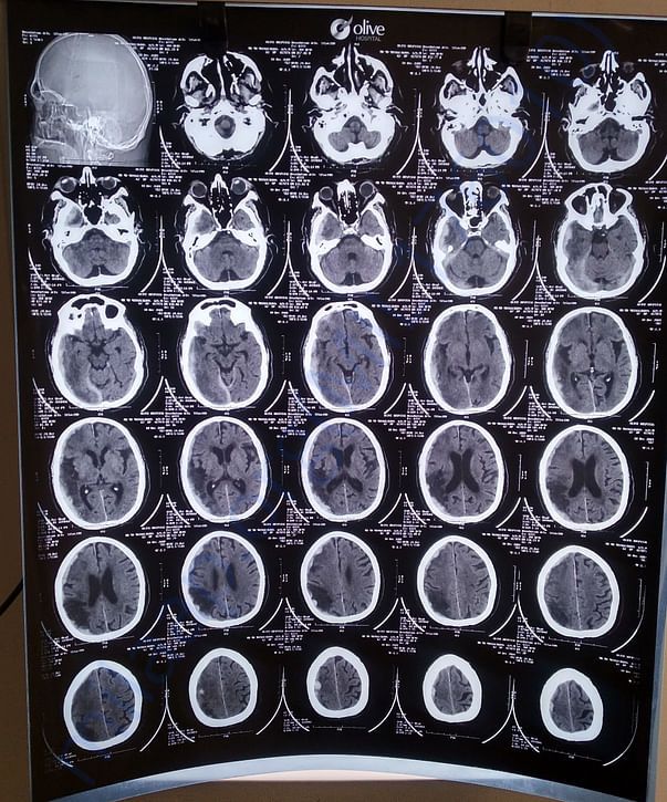 Help My Uncle Recover from Brain Hemorrhage and Hip Replacement