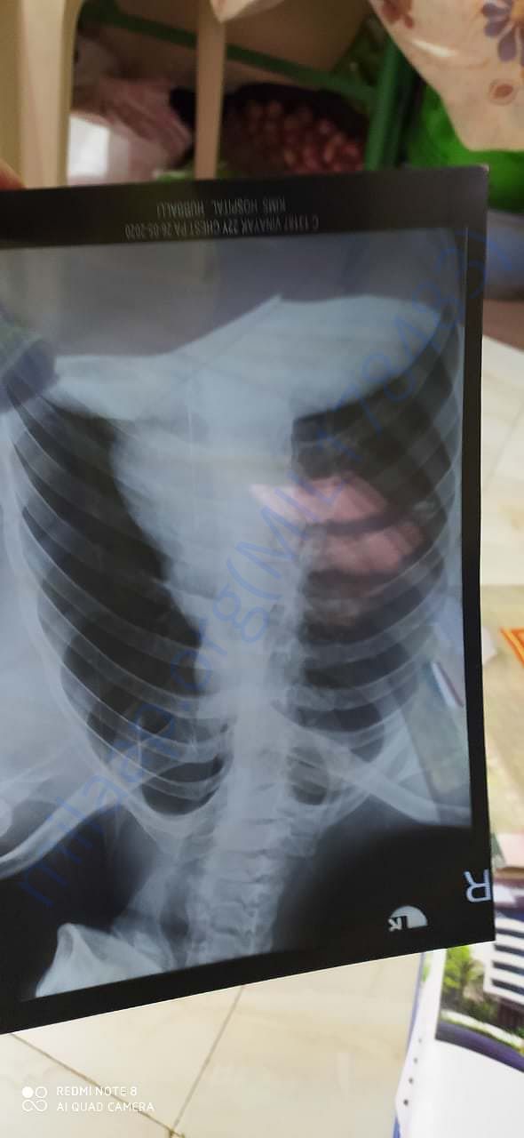 Xray copy of spinal cord which is deformed and deranged due to coma