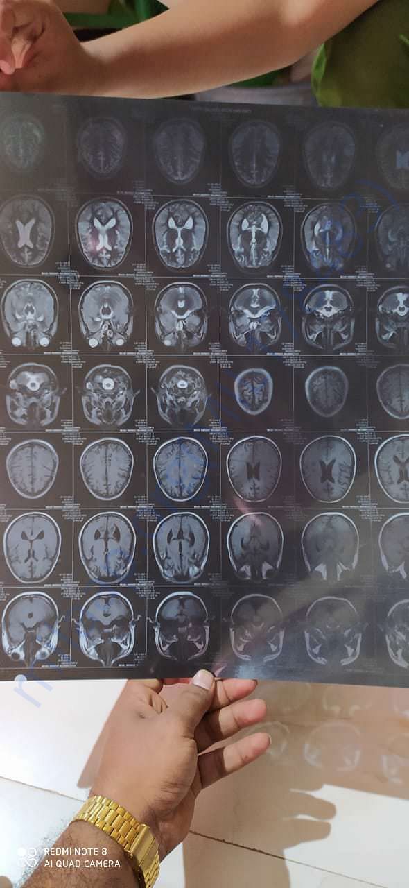 MRI scan of Brain