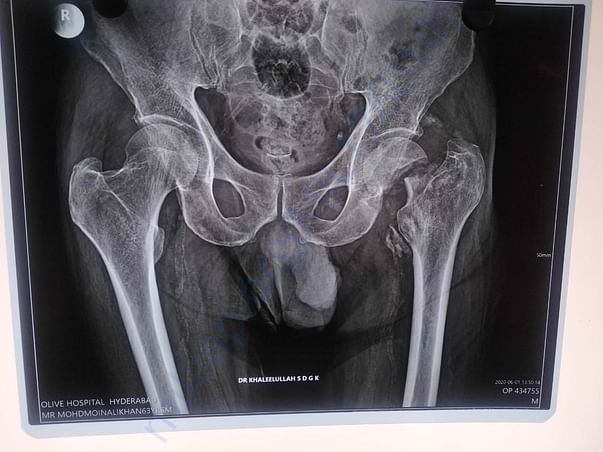 HIP-BROKENX-RAY-OLIVE-HOSPITAL
