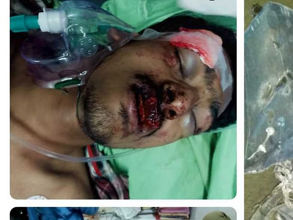 My Brother Is Struggling With Accident Injuries, Help Him