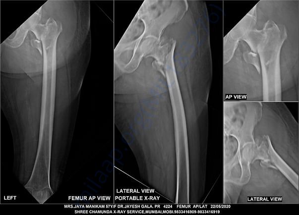 Hip_Bone_X_Ray