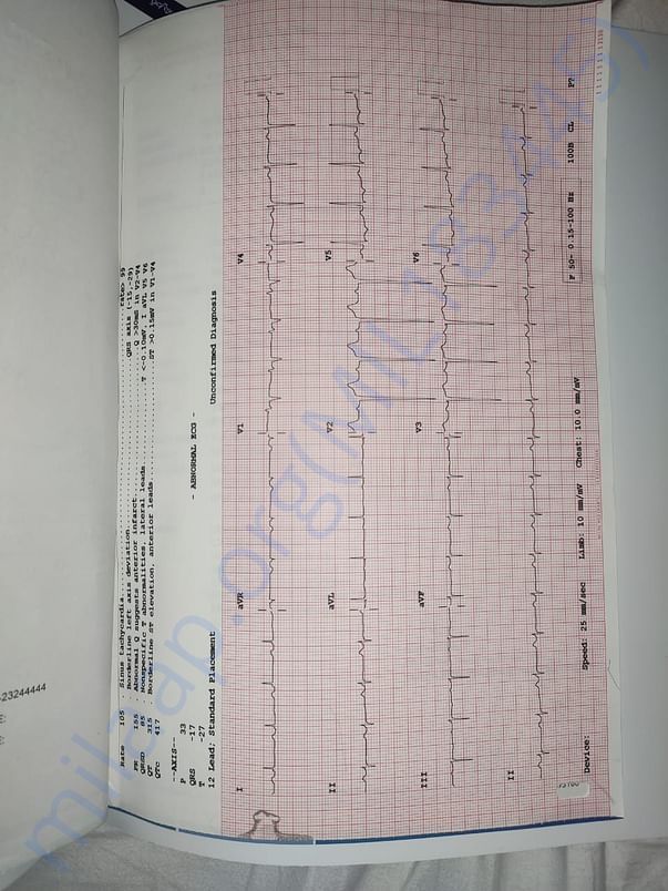 Ecg